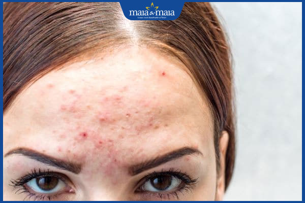 tình trạng viêm lỗ chân lông trên mặt