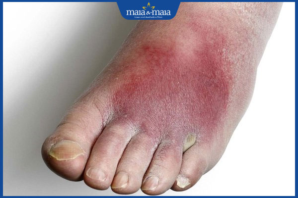 tình trạng viêm mô tế bào