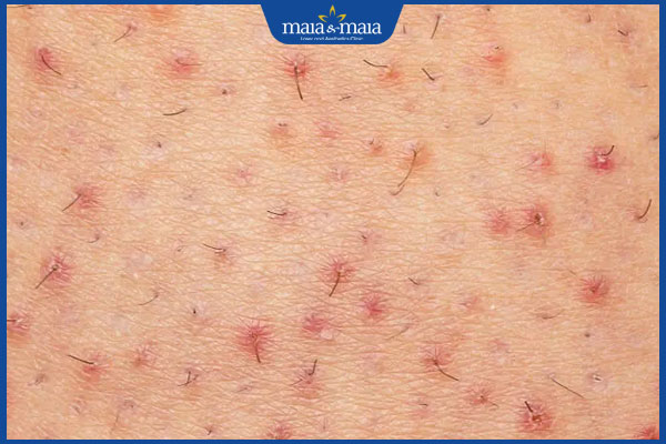 Viêm nang lông: Dấu hiệu, nguyên nhân và cách điều trị 2 tình trạng viêm nang lông