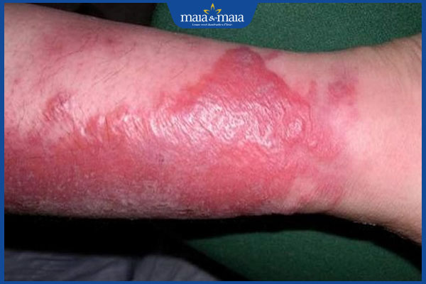 Nhiễm trùng da do vi khuẩn có nguy hiểm không? Cách điều trị 6 tình trạng viêm nặng