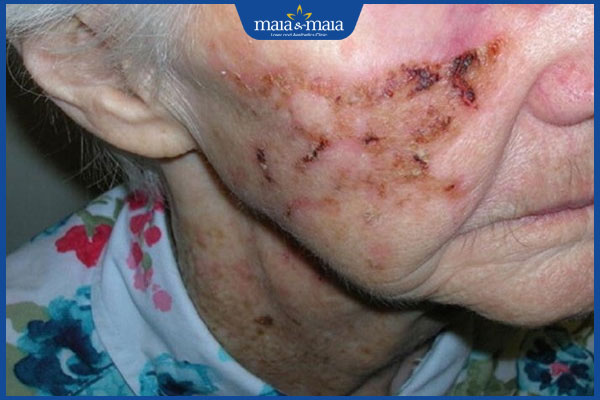 tình trạng zona ở người cao tuổi