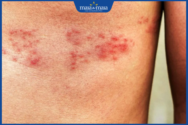 Zona thần kinh liên sườn: Nguyên nhân và hướng điều trị 2 tình trạng zona thần kinh liên sườn