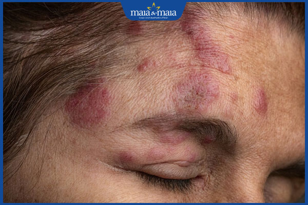 tình trạng zona thần kinh trên mặt