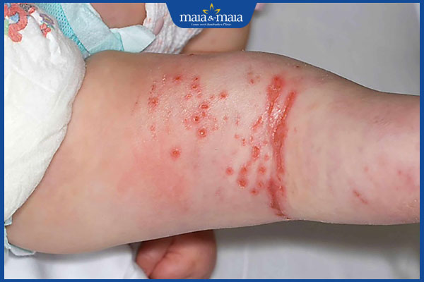 Viêm da cơ địa bội nhiễm có nguy hiểm không? Cách điều trị 4 trẻ bị nhiễm trùng toàn thân