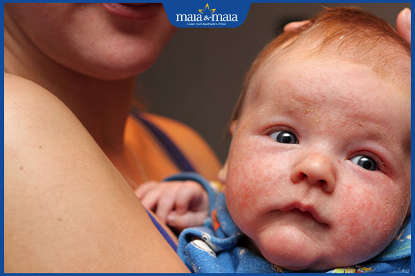 Chi tiết cách chăm sóc trẻ bị viêm da cơ địa tại nhà 2 trẻ bị viêm da cơ địa