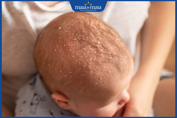 Viêm da đầu ở trẻ em: Cách điều trị và phòng ngừa hiệu quả 2 trẻ bị viêm da đầu