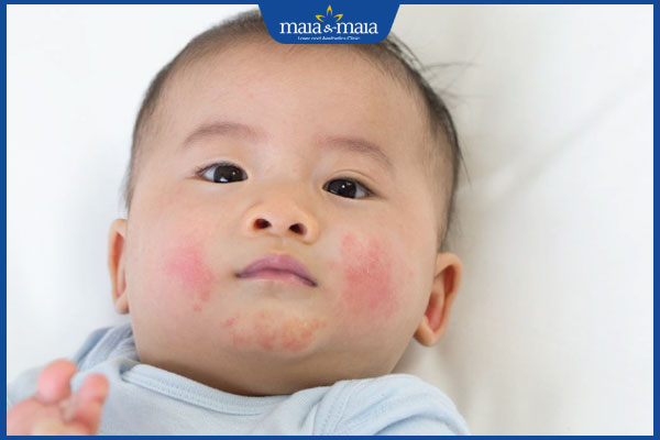 Viêm da dị ứng ở mặt có nguy hiểm không? Cách điều trị 5 trẻ bị viêm da dị ứng mặt