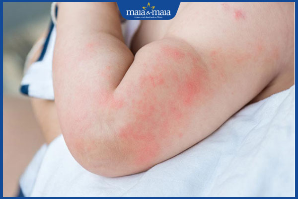 Viêm da dị ứng: Triệu chứng, nguyên nhân và cách điều trị 6 trẻ bị viêm da dị ứng