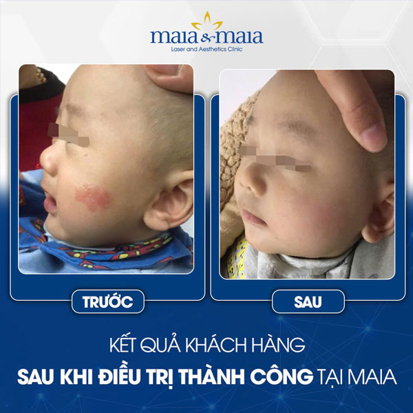Chi tiết cách chăm sóc trẻ bị viêm da cơ địa tại nhà 10 trẻ chữa viêm da thành công tại maia