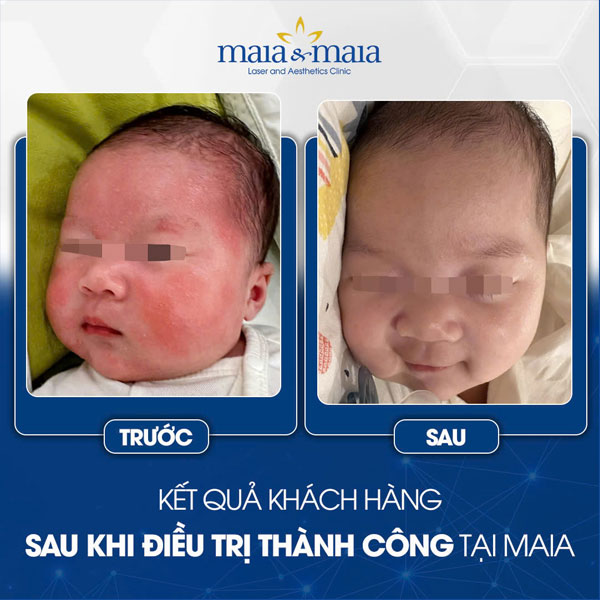 Chi tiết cách chăm sóc trẻ bị viêm da cơ địa tại nhà 9 trẻ chữa viêm da thành công