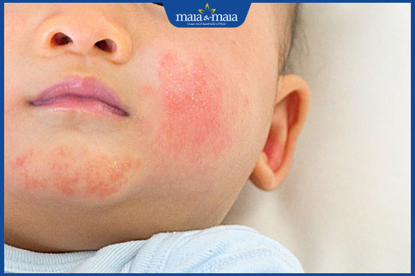Viêm da dị ứng ở trẻ em: Dấu hiệu nhận biết và cách điều trị 3 trẻ dị ứng mặt