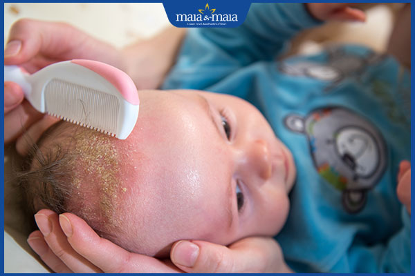 Viêm da đầu ở trẻ em: Cách điều trị và phòng ngừa hiệu quả 3 trẻ mắc viêm da đầu