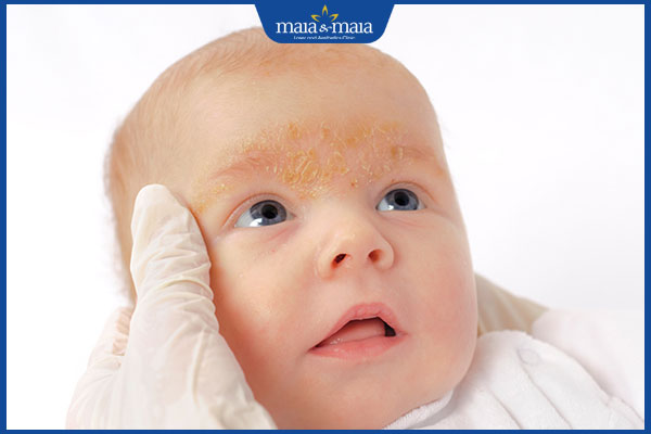 Viêm da tiết bã ở trẻ nhỏ có nguy hiểm không? Cách điều trị 3 trẻ sơ sinh viêm da tiết bã