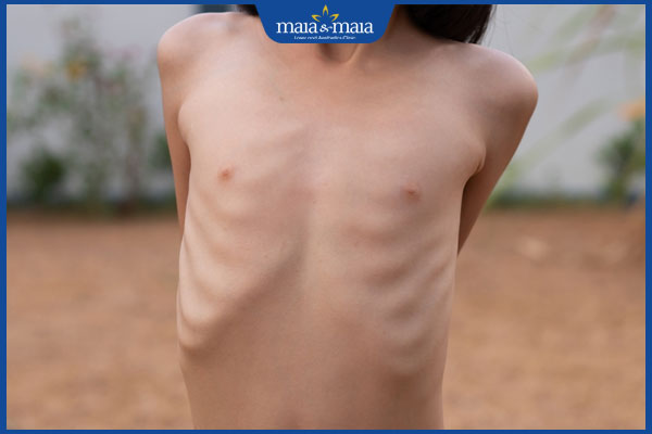 trẻ suy dinh dưỡng