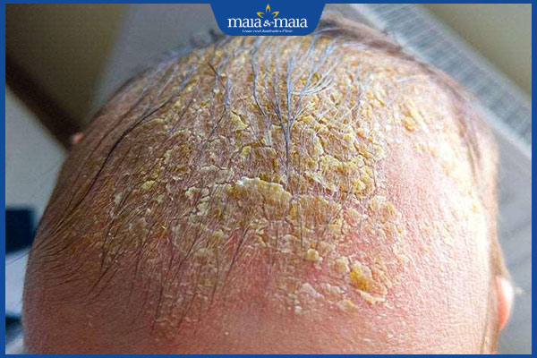 Viêm da dầu: Triệu chứng, chẩn đoán, điều trị và phòng ngừa 7 trẻ viêm da dầu