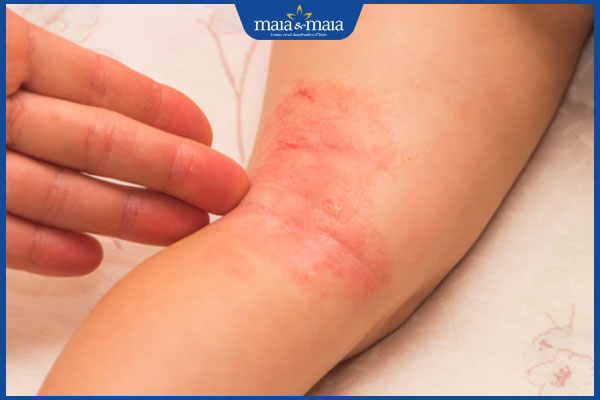 Viêm da dị ứng ở trẻ em: Dấu hiệu nhận biết và cách điều trị 4 trẻ viêm da dị ứng tay chân