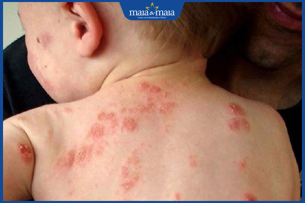 Điều trị viêm da mủ ở trẻ sơ sinh như thế nào? Làm sao để phòng bệnh? 2 trẻ viêm da mủ