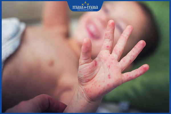 Viêm nang lông ở trẻ em do đâu? Cách điều trị và phòng ngừa 3 trẻ viêm nang lông bàn tay