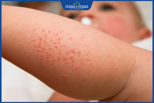 Viêm nang lông ở trẻ em do đâu? Cách điều trị và phòng ngừa 5 trẻ viêm nang lông chân