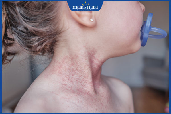 Viêm nang lông ở trẻ em do đâu? Cách điều trị và phòng ngừa 2 trẻ viêm nang lông cổ