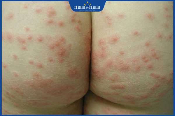 Viêm nang lông ở trẻ em do đâu? Cách điều trị và phòng ngừa 6 trẻ viêm nang lông mông