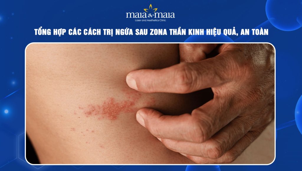 trị ngứa sau zona thần kinh
