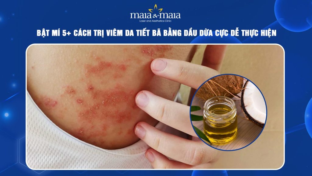 Bật mí 5 cách trị viêm da tiết bã bằng dầu dừa dễ dàng 1 trị viêm da tiết bã bằng dầu dừa