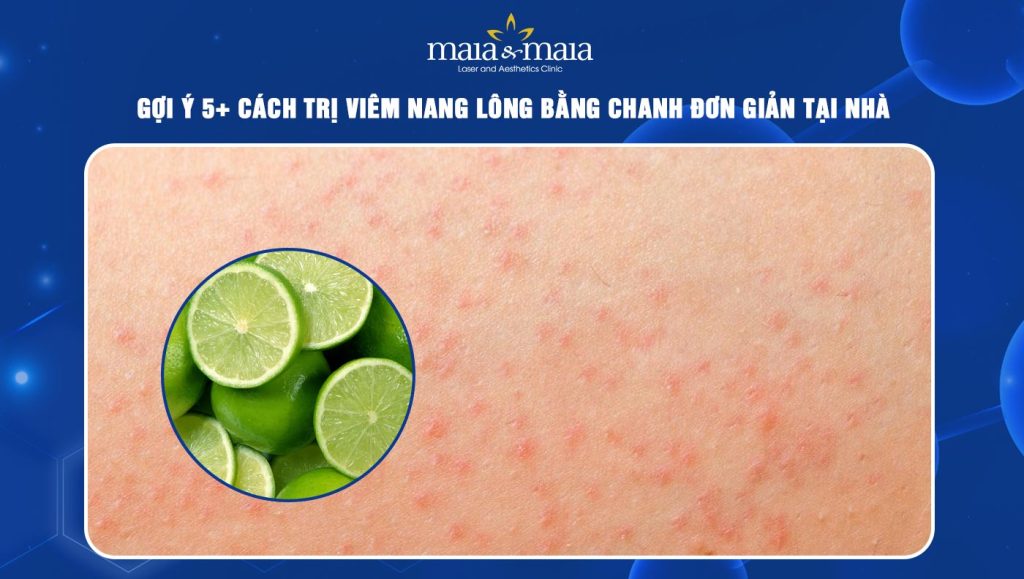 Trị viêm nang lông bằng chanh