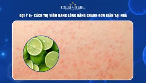 Trị viêm nang lông bằng chanh