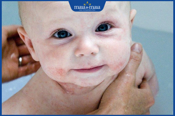 vệ sinh cho người bị viêm da