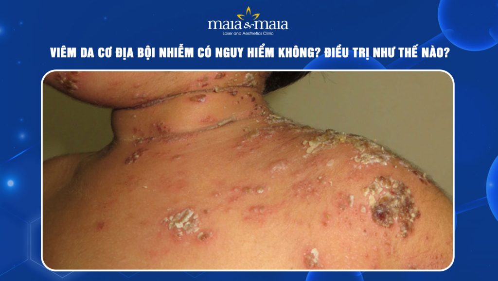 Viêm da cơ địa bội nhiễm có nguy hiểm không? Cách điều trị 1 Viêm da cơ địa bội nhiễm