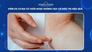 viêm da cơ địa có chữa được không