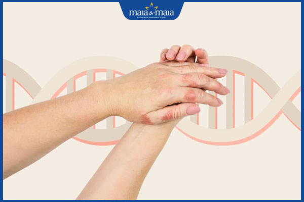 viêm da cơ địa có tính di truyền