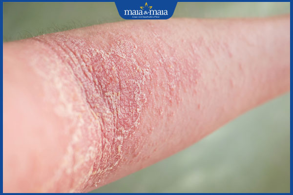 viêm da cơ địa dày sừng