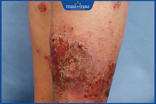 Viêm da cơ địa sau sinh: Nguyên do, triệu chứng và điều trị 3 viêm da cơ địa gây viêm loét