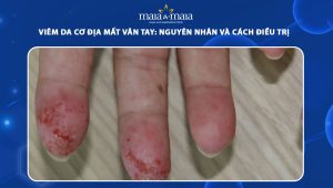 viêm da cơ địa mất vân tay