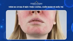 viêm da cơ địa ở mặt