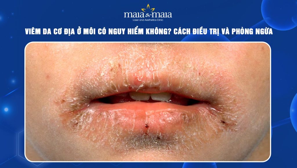 Viêm da cơ địa ở môi có nguy hiểm không? Điều trị thế nào? 1 Viêm da cơ địa ở môi
