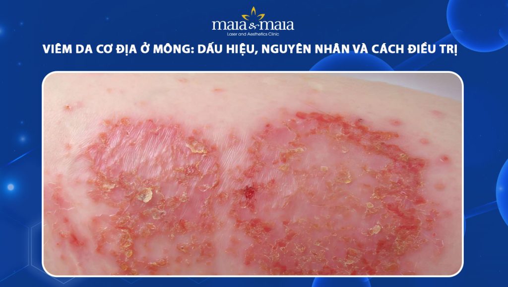 viêm da cơ địa ở mông