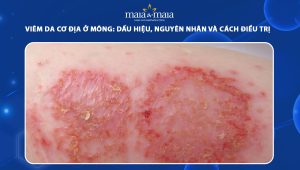 viêm da cơ địa ở mông