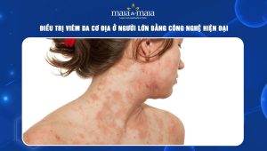 Viêm da cơ địa ở người lớn