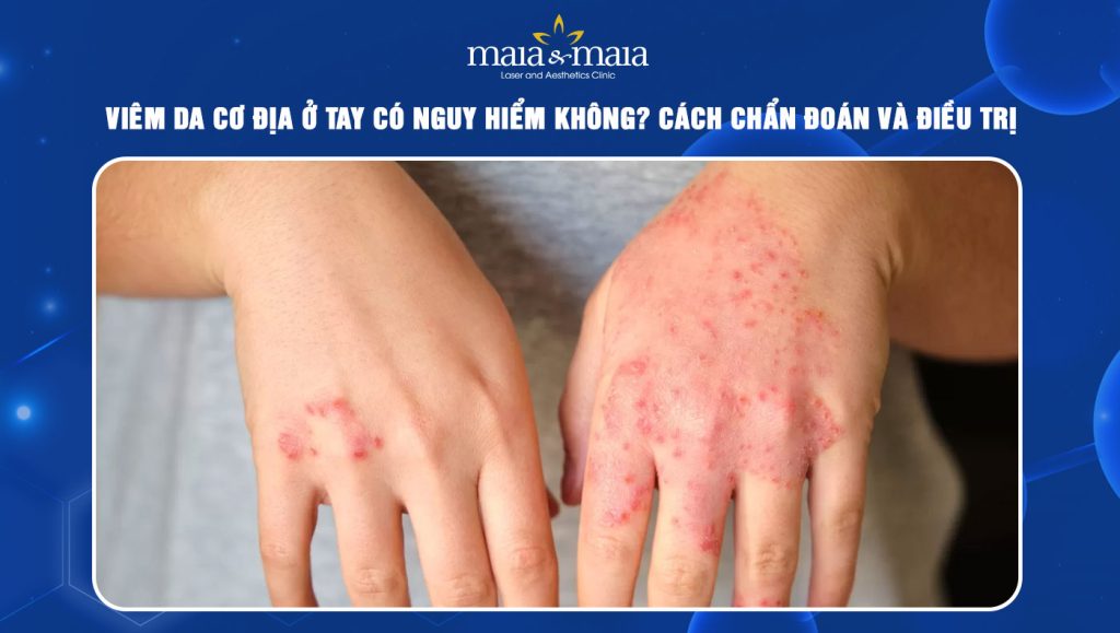 Viêm da cơ địa ở tay