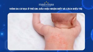 viêm da cơ địa ở trẻ em