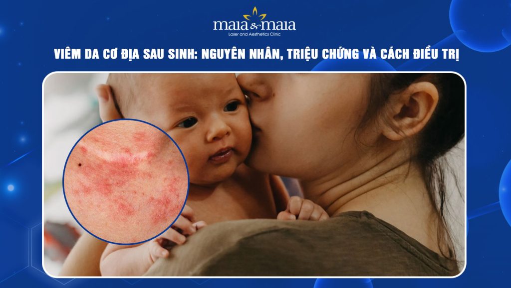 Viêm da cơ địa sau sinh: Nguyên do, triệu chứng và điều trị 1 Viêm da cơ địa sau sinh