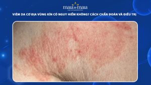 viêm da cơ địa vùng kín