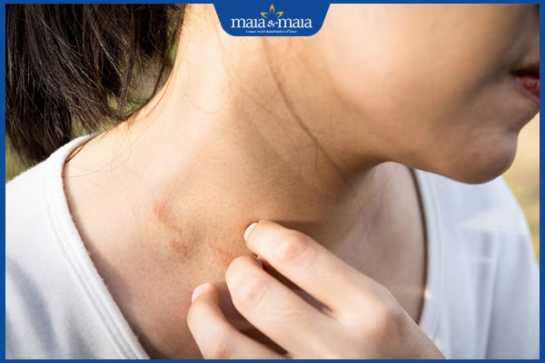 viêm da cổ gây ngứa