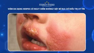 viêm da dạng herpes