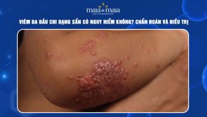 Viêm da đầu chi dạng sẩn