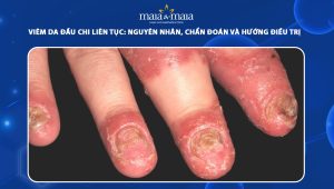 viêm da đầu chi liên tục