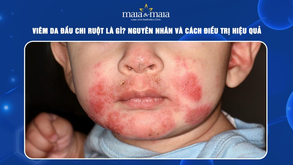 Viêm da đầu chi ruột là gì? Nguyên nhân và cách điều trị 1 Viêm da đầu chi ruột